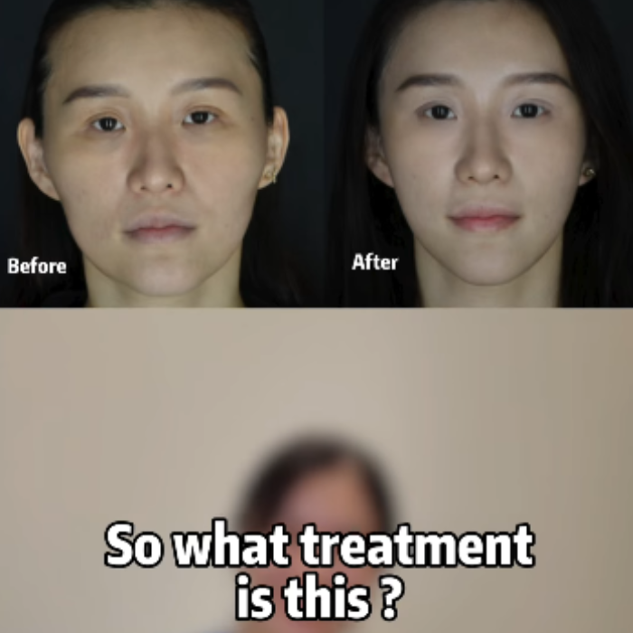 Profhilo Structura non surgical face lifting treatment at Lyvin Clinic JB